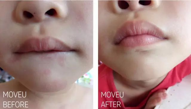 “万用”紫草膏，解决了你多少皮肤烦恼？