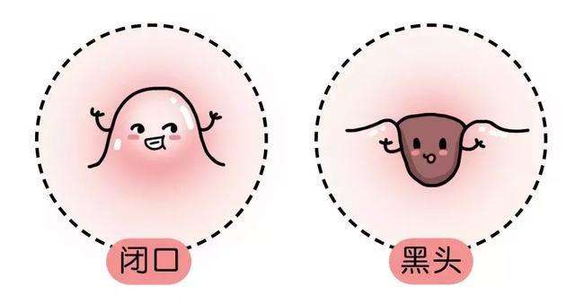 远离痘痘肌还原肌肤好状态,远离痘痘你需要怎么做