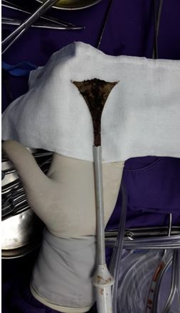 调理子宫内膜的中医疗法,女性内膜修补术过程