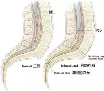器质性遗尿症是由于什么引起,脊髓栓系造成的遗尿特征