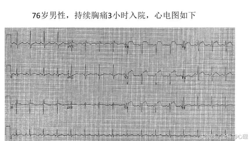 一文读懂血汗管疾病,左室心梗和右室心梗