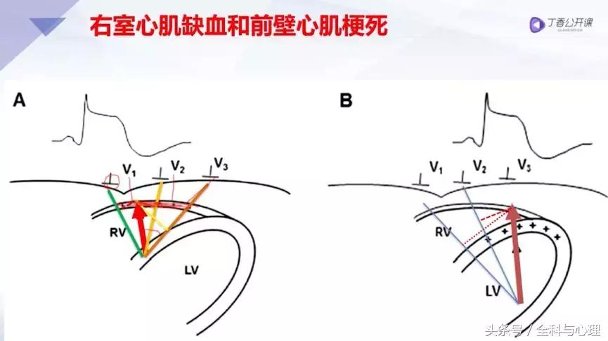 一文读懂血汗管疾病,左室心梗和右室心梗