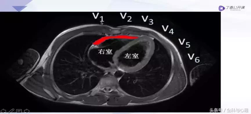 一文读懂血汗管疾病,左室心梗和右室心梗