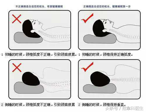 颈椎病七型,颈椎生理曲度变直要哪种枕头