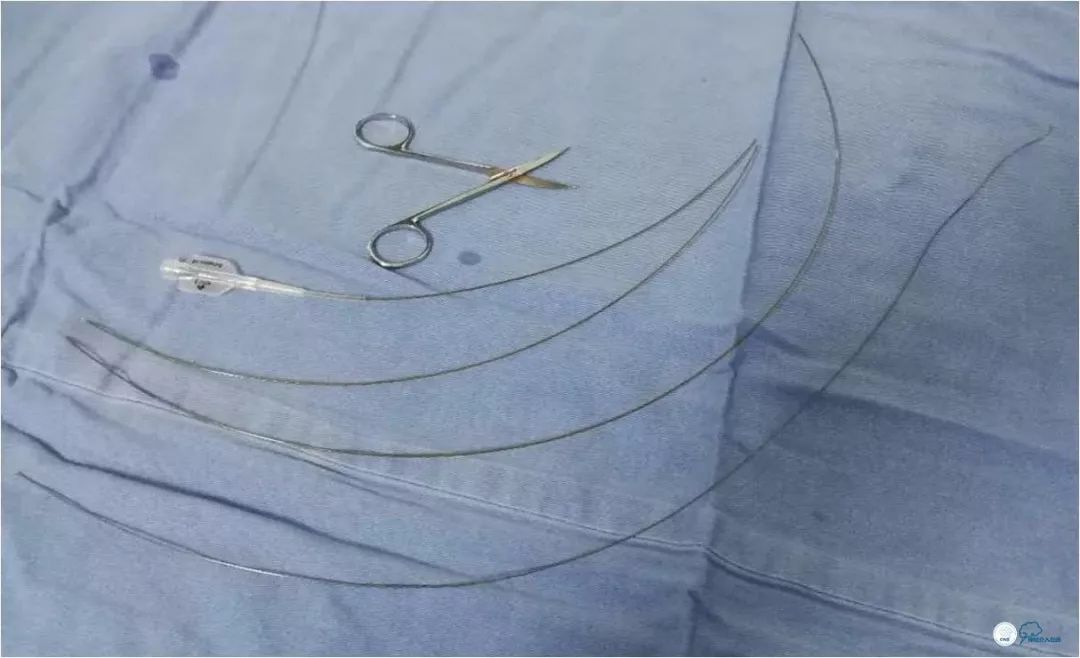 天坛医院住院日记,颈内动脉c5到c7段狭窄微创手术