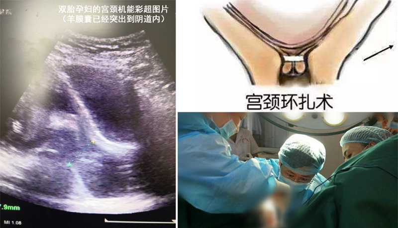 妇幼保健院三胞胎,妇幼保健院4胞胎