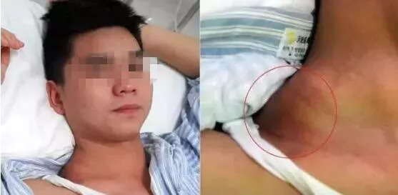 身上有20个黑痣,老人身上的小黑痣是癌吗