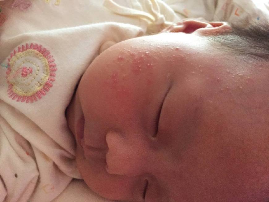 宝宝湿疹很痒光抓怎么帮宝宝缓解,宝宝湿疹痒有什么好办法