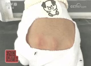 驱蚊贴再也不怕蚊子咬了,用了防蚊贴过敏