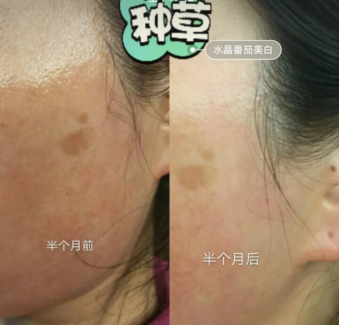 坚持7天的细纹消失,没有细纹但是有斑点