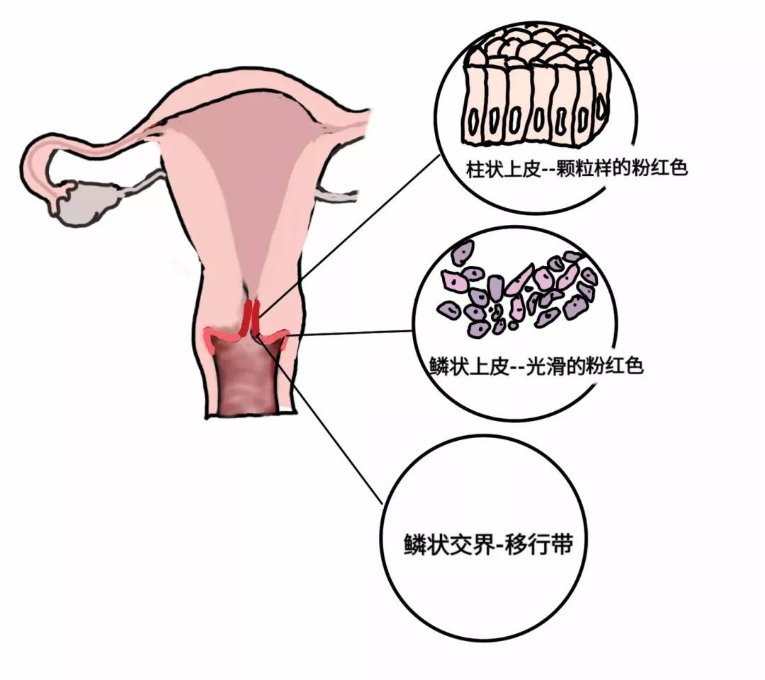 女性宫颈糜烂是什么原因引起的,女性宫颈糜烂有什么症状和现象