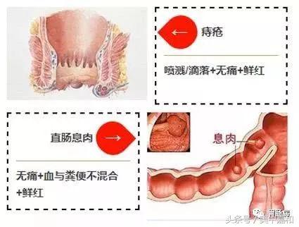 暗红色的便血一定是肠癌吗,大便便血是什么病的前兆
