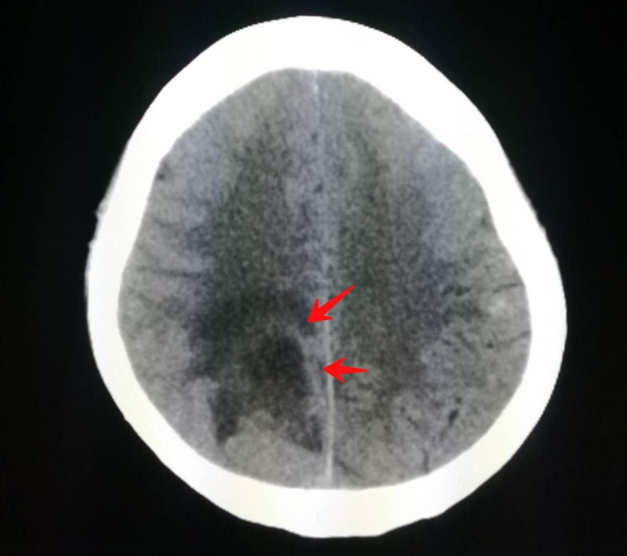 4种症状要查脑血管,这些症状一定要做脑血管造影