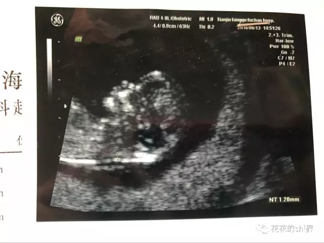 nt检查怎么没有图像,nt检查一般什么情况下不合格