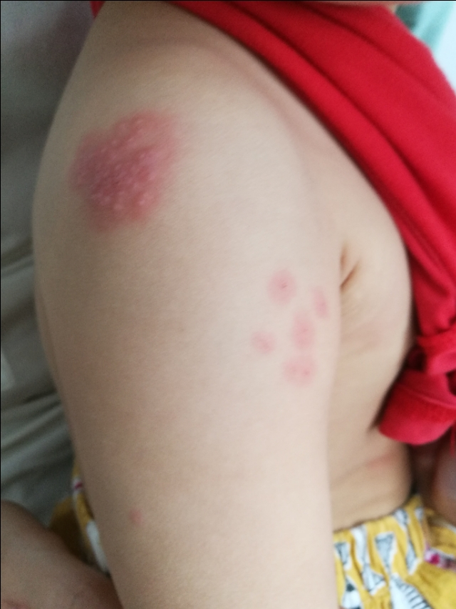 宝宝得了带状疱疹还会长水痘吗,5个月的宝宝会得带状疱疹么