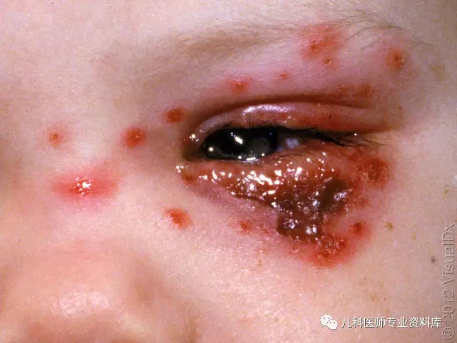 宝宝嘴巴上火的症状,宝宝嘴巴臭是积食还是上火