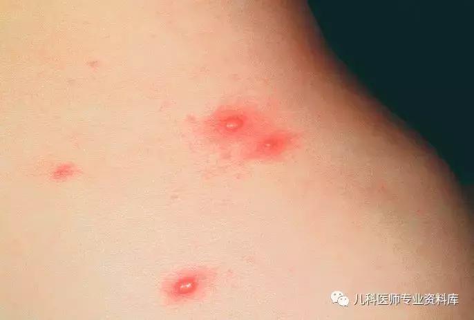 宝宝嘴巴上火的症状,宝宝嘴巴臭是积食还是上火