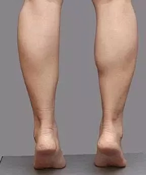肌肉型小腿，我该怎么瘦下来？