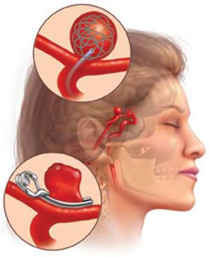 脑动脉瘤破裂手术后如何锻炼,腹主动脉瘤微创手术后如何锻炼