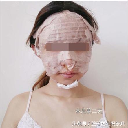 自体脂肪术后关注事项,自体脂肪脸部填充不忌口会怎样