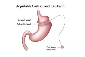 胖子和糖尿病人都有救了，最新荷尔蒙问世，不用手术