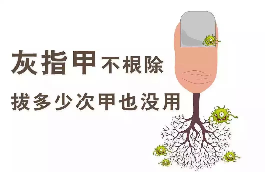 只用药不口服能治好灰指甲吗,灰指甲吃药没用
