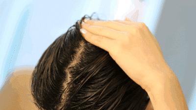 头皮和身上长痘,头皮油脸长痘