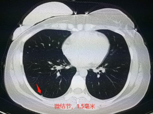 几毫米的肺结节需要随访,5毫米肺结节随访一年无变化