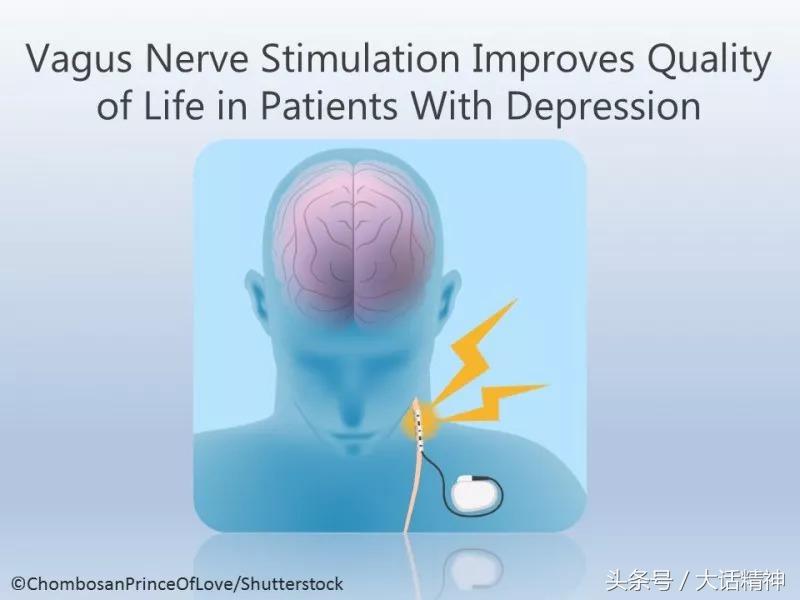 抑郁症研究：迷走神经刺激，-3补充，青少年精神病学