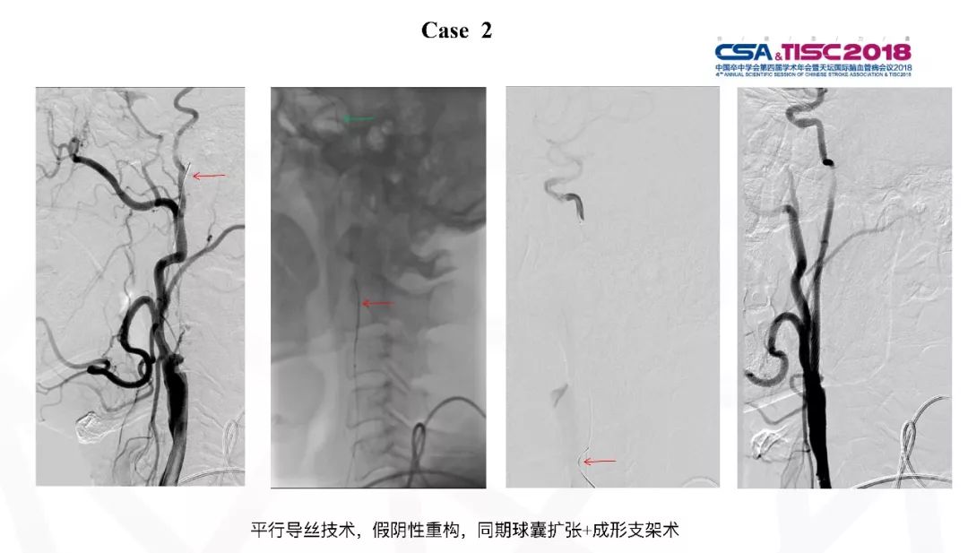 颈动脉狭窄介入治疗术后血压管理,专家讲解颈动脉狭窄的诊疗