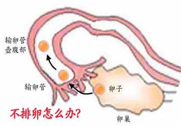 不孕不育不排卵怎么办,不排卵怎么治好