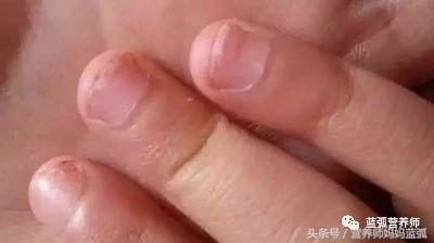 宝宝指甲白斑、凹陷、扁平、分层、脱皮别不在意，有的提示重病！