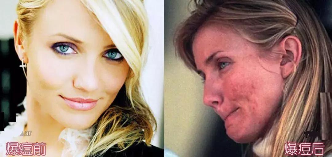 战痘的四个小方法,战痘女孩的秘笈