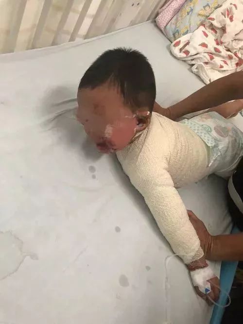 宝宝被开水烫伤妈妈去救他,婴儿被100开水烫伤后续