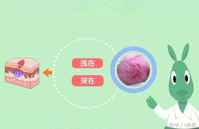 血管瘤常见问题之：海绵状血管瘤的诊断及治疗！
