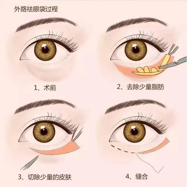 马东眼袋消除前后对比,马东去眼袋效果