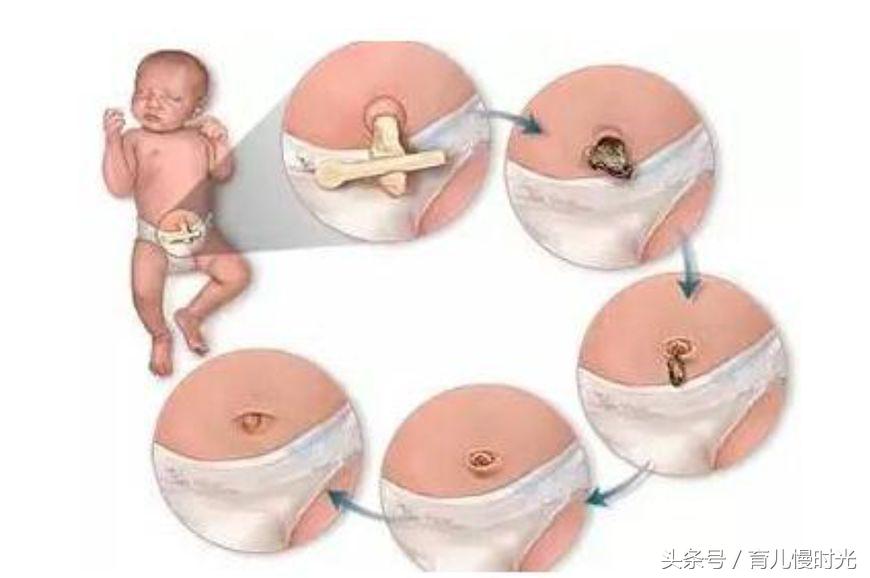 治消化不良腹泻的肚脐贴,婴儿腹泻呕吐用什么肚脐贴好