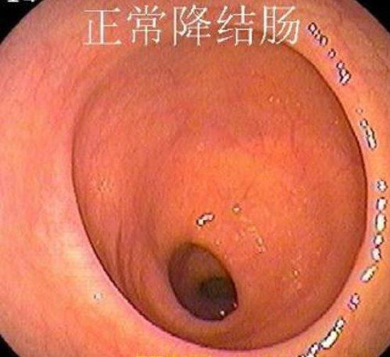 正常肠镜报告单图片大全,正常肠道的肠镜图片