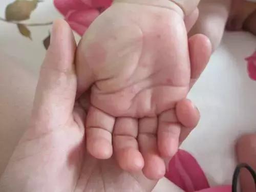 手足口疫苗接种副作用,打了手足口疫苗腹泻怎么办