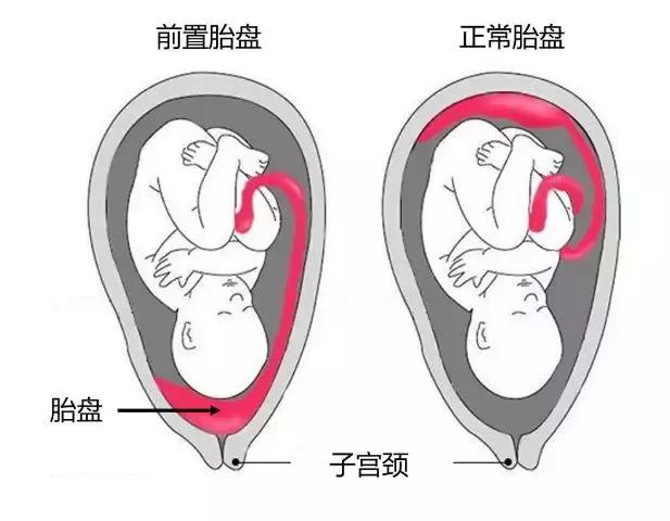 如何选择剖宫产还是顺产,建议剖宫产还是顺产