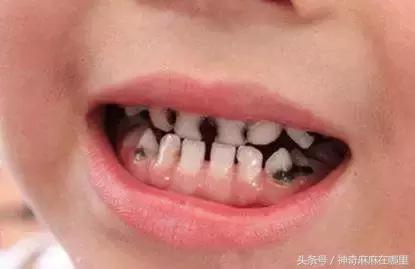 乳牙磕掉半颗怎么办,宝宝乳牙磕掉一小块怎样补救