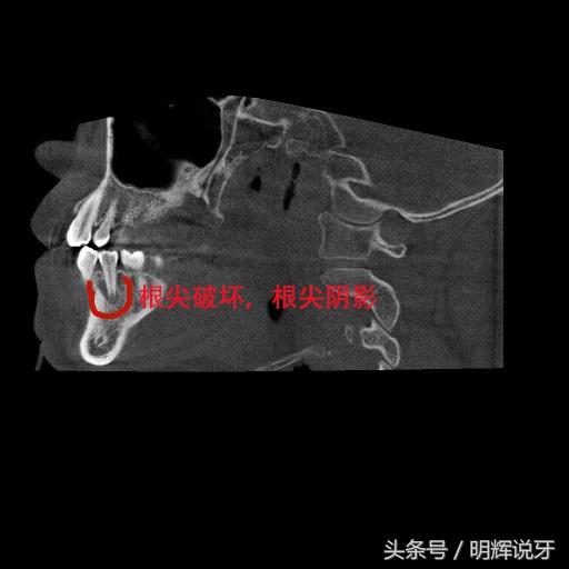 儿童尖牙可以怎么治疗,儿童牙尖炎的症状怎样治疗