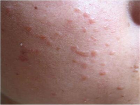 扁平疣不去抓它会继续扩大范围吗,扁平疣抓掉了用什么药好