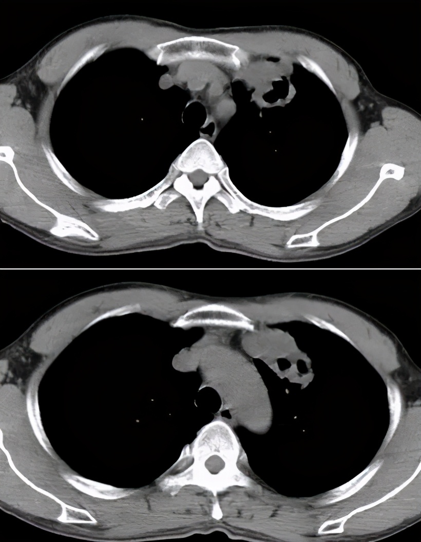 肺结核防控诊疗方案,成功治疗肺结核病的关键