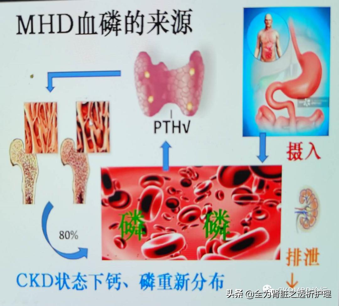 血磷控制，为什么那么难？