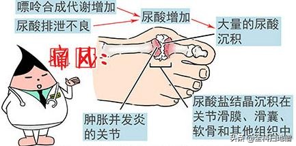 非布司他降尿酸，何时用？何时停？用多少？