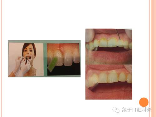 蛀牙治疗科普,蛀牙安全有效的方法