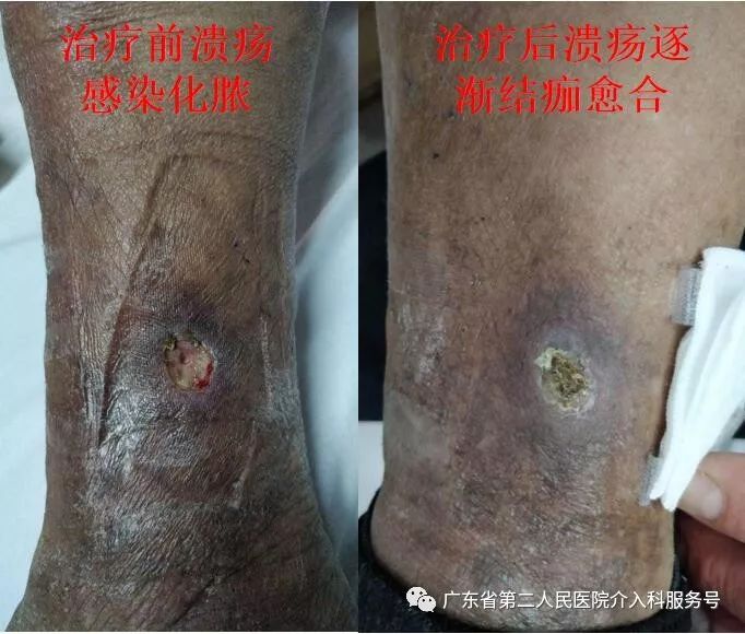 静脉曲张溃疡中药治疗,下肢静脉曲张溃疡用哪些消炎药