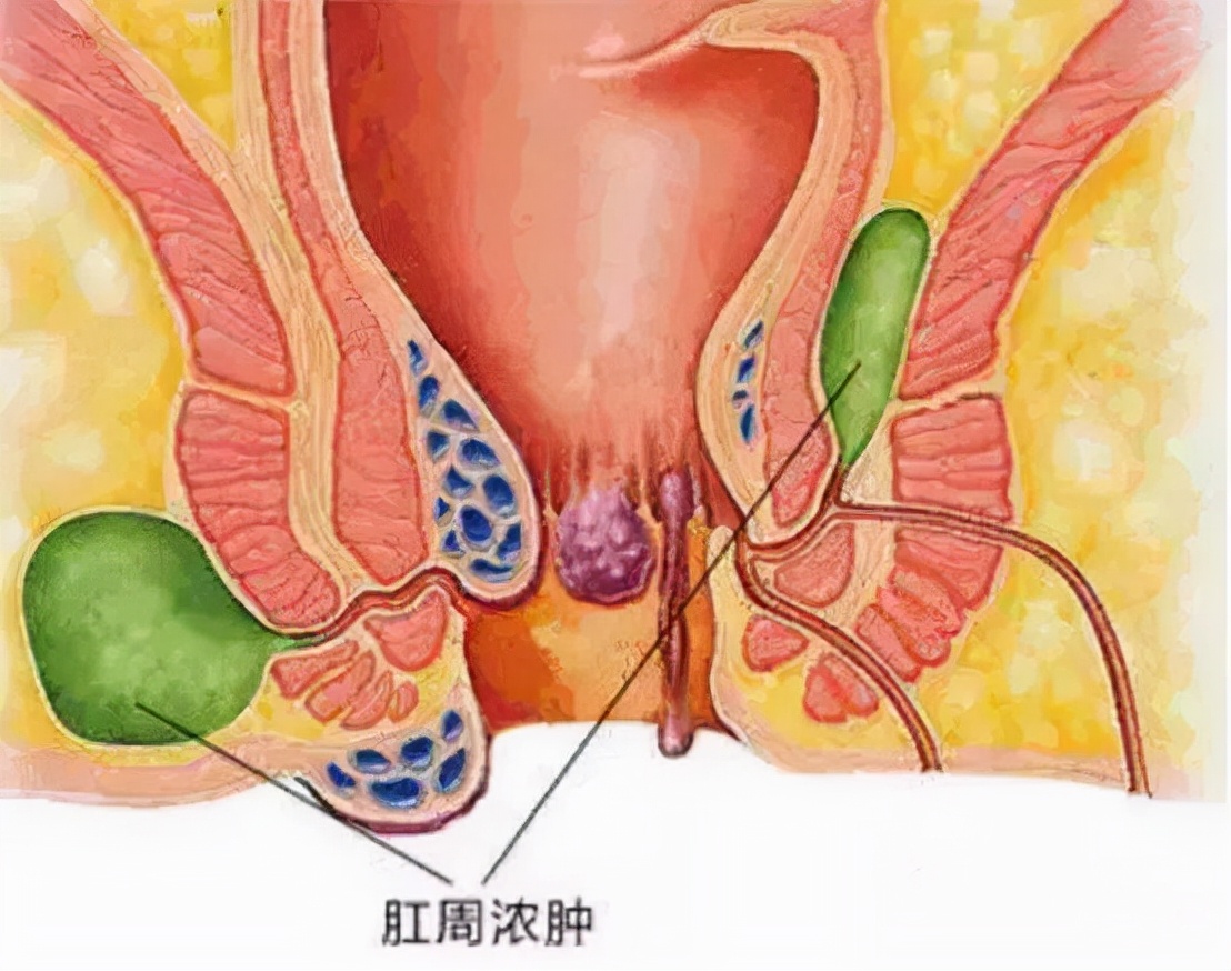 屁股里总感觉夹了个东西怎么办,肛门坠胀是焦虑引起的躯体症状吗