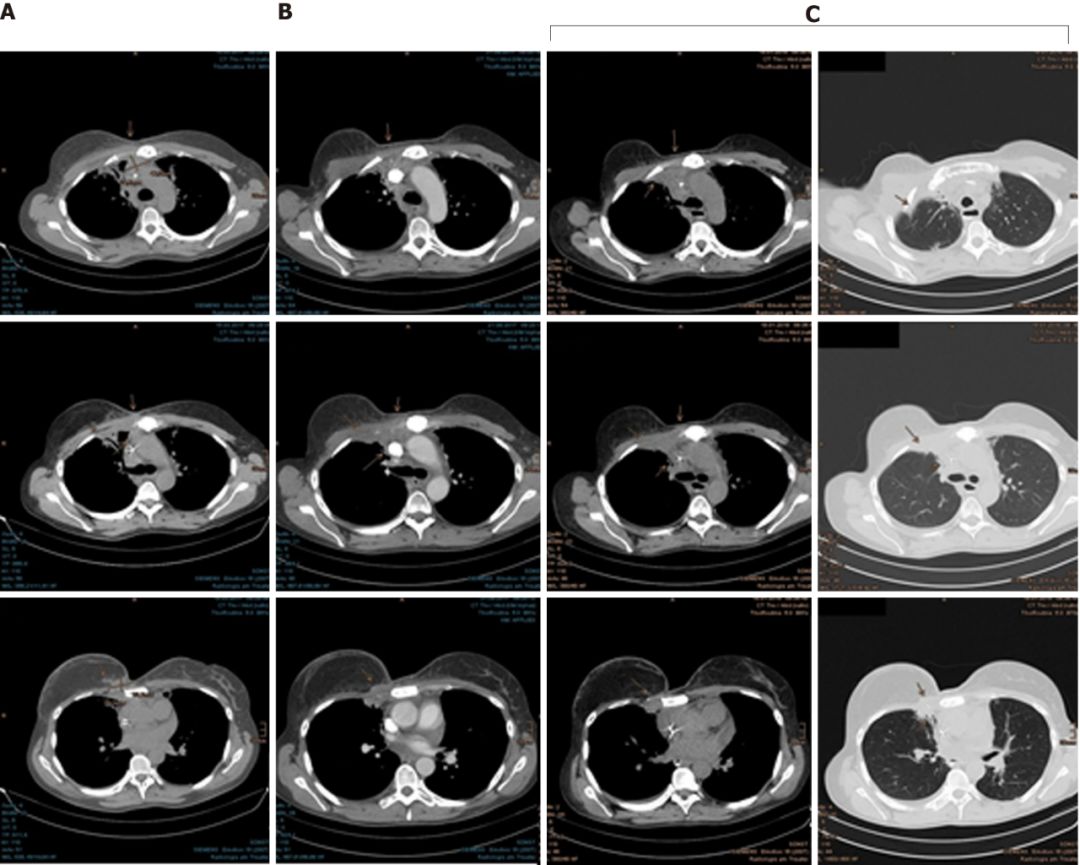 乳腺癌10年,十年乳腺癌患者
